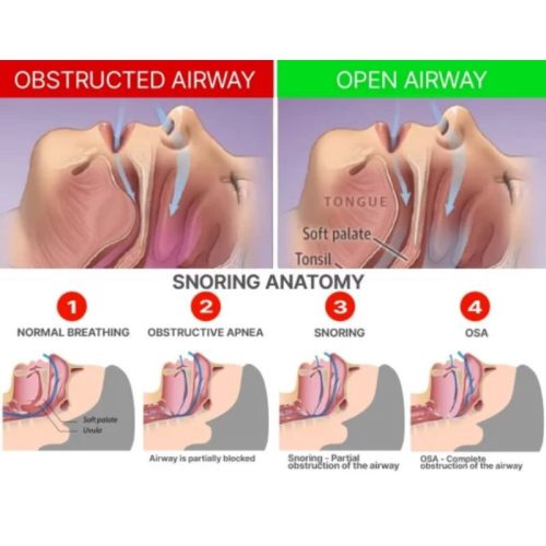 Chránič zubů DreamHero proti chrápání – pomůcka pro polohování čelisti pro klidný spánek